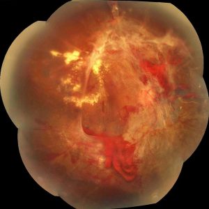 Decolare de retina cu tractiuni retiniene